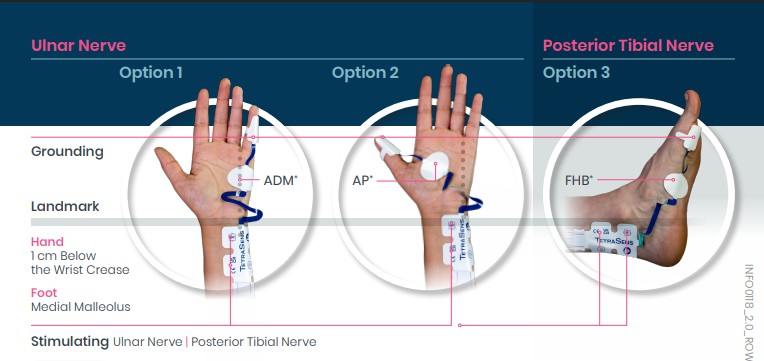 Tre diagram visar elektrodplaceringar på händer för ulnarisnerven och foten för stimulering av bakre tibi nerven.